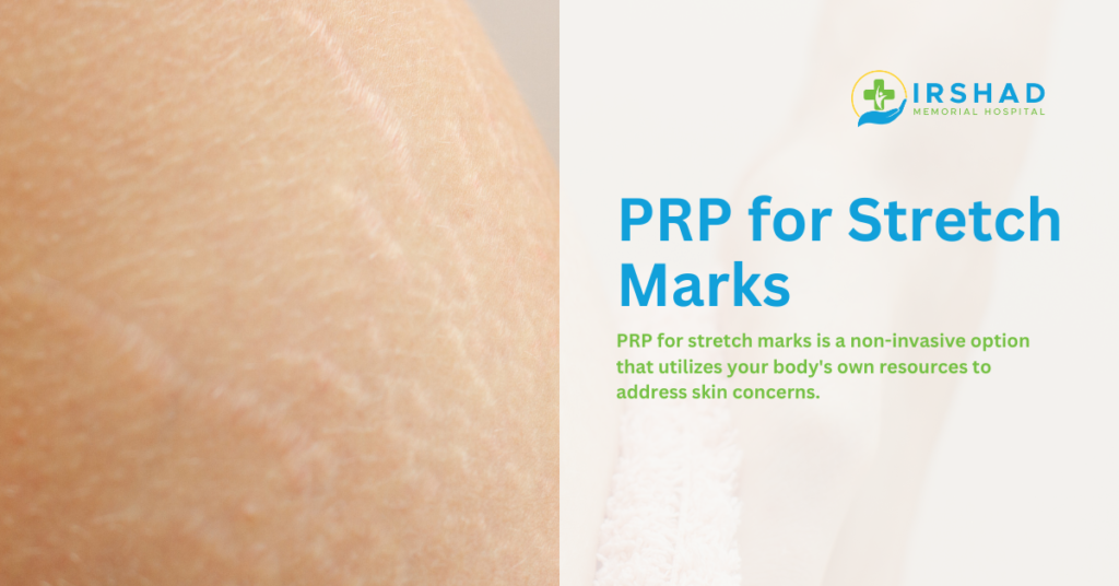 PRP for  Stretch Marks