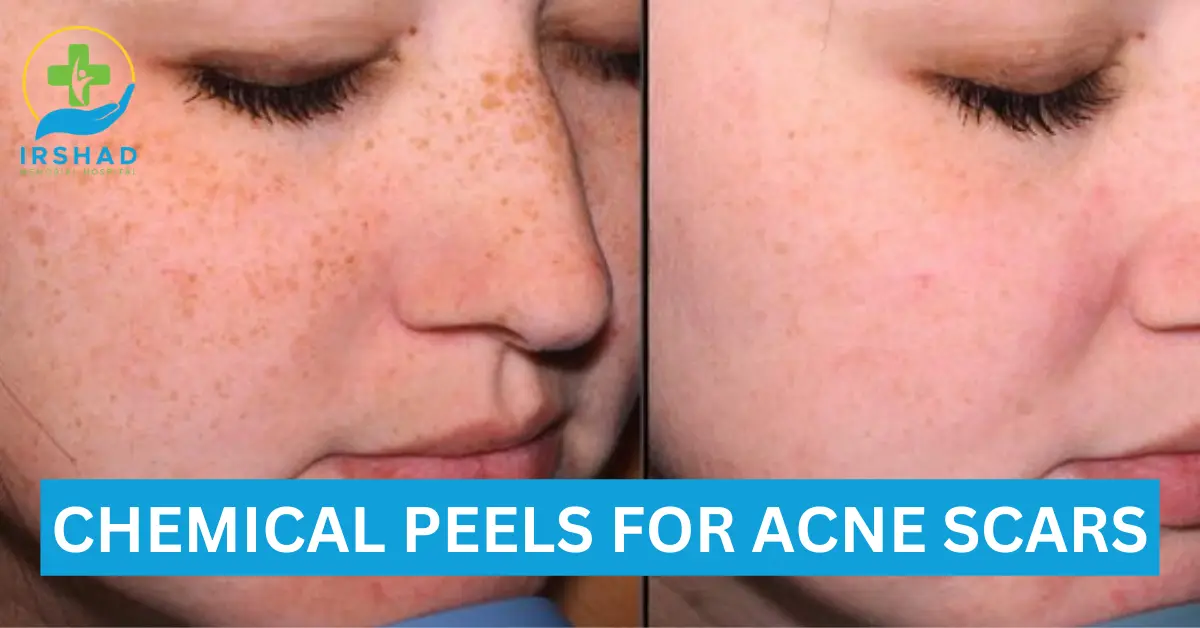 CHEMICAL PEELS FOR ACNE SCARS